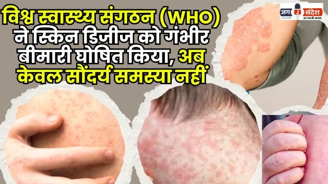 The World Health Organization has declared skin diseases a serious illness