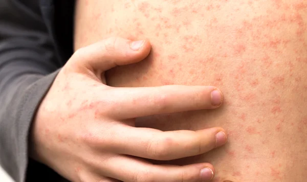 विश्व स्वास्थ्य संगठन (WHO) ने स्किन डिजीज को गंभीर बीमारी घोषित किया, अब केवल सौंदर्य समस्या नहीं : The World Health Organization has declared skin diseases a serious illness 3 image 262