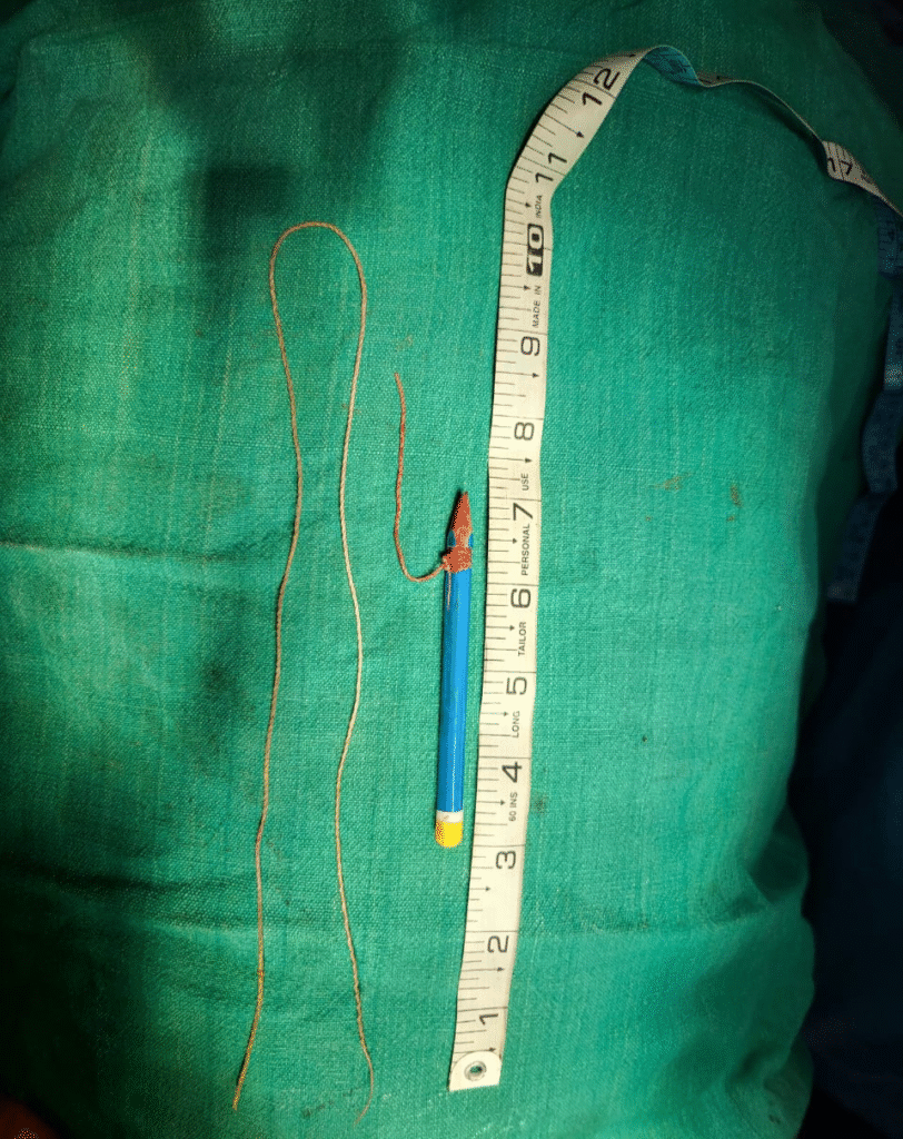 अंबिकापुर अस्पताल में अजीब मामला: कैदी के शरीर में फंसी पेंसिल, मूत्र रुकने से हुई परेशानी : Ambikapur hospital Pencil stuck in prisoner's body 3 image 350